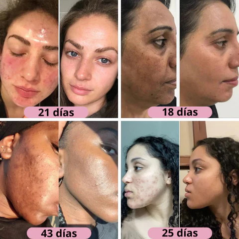 PeleSaudável™ - Pensos nutritivos para o rosto 2x1: Ácido Kójico e Curcuma